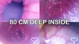 Endoscope anal dans mon Transverse Colon - Vidéo complète sur Manyvids et Fansly